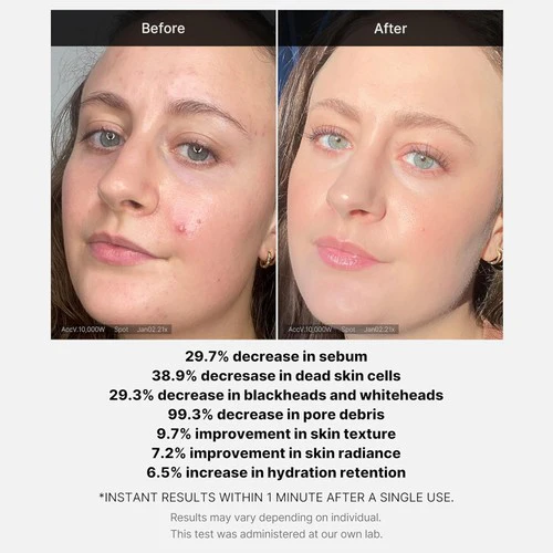 MEDICUBE 1 MIN RED ACNE SUCCINIC ACID PEEL 40 G
